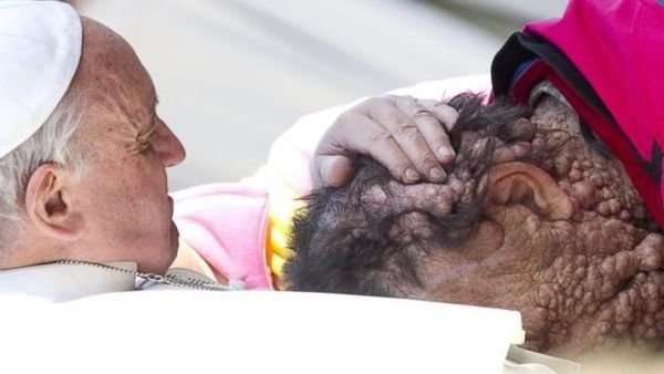 Pop Francis blesses a man suffering from a skin disorder
